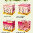 Queimaduras: Como se trata os diferentes tipos de queimaduras! Os médicos classificam as queimaduras em três graus, de acordo com sua profundidade. A gravidade, no entanto, depende de vários outros fatores, como extensão e localização – se for no...