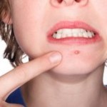 Doenças e tratamentos: acne