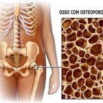 Prevenindo a OSTEOPOROSE