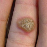 Tratamentos para remover verrugas